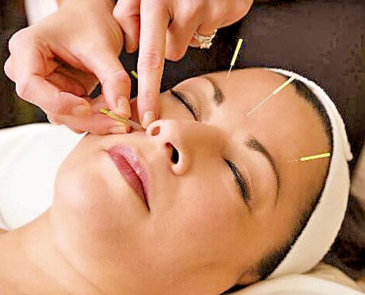 Traditional acupuncture treatment