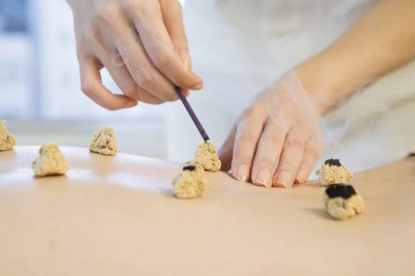 Moxibustion Therapy